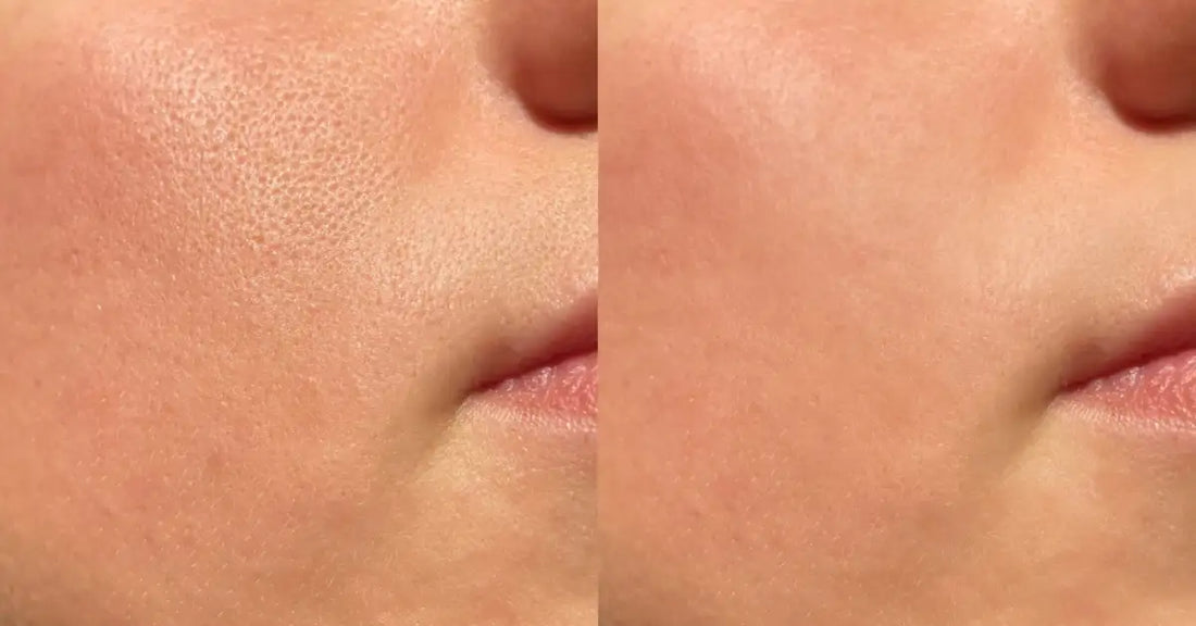 A fresh and matte face after using the Best Serum for Oily Skin