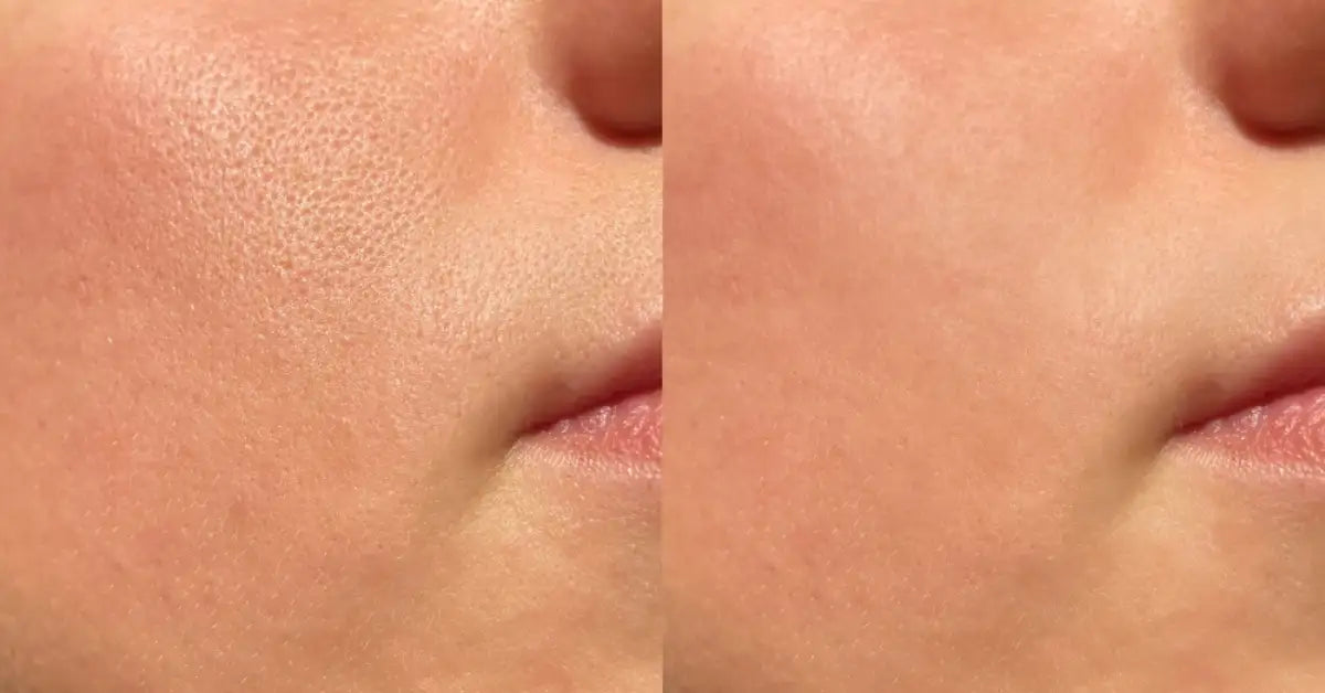 A fresh and matte face after using the Best Serum for Oily Skin