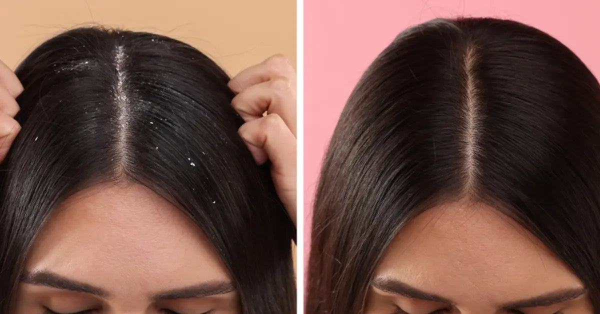 Scalp comparison showing results from an effective Dandruff treatment