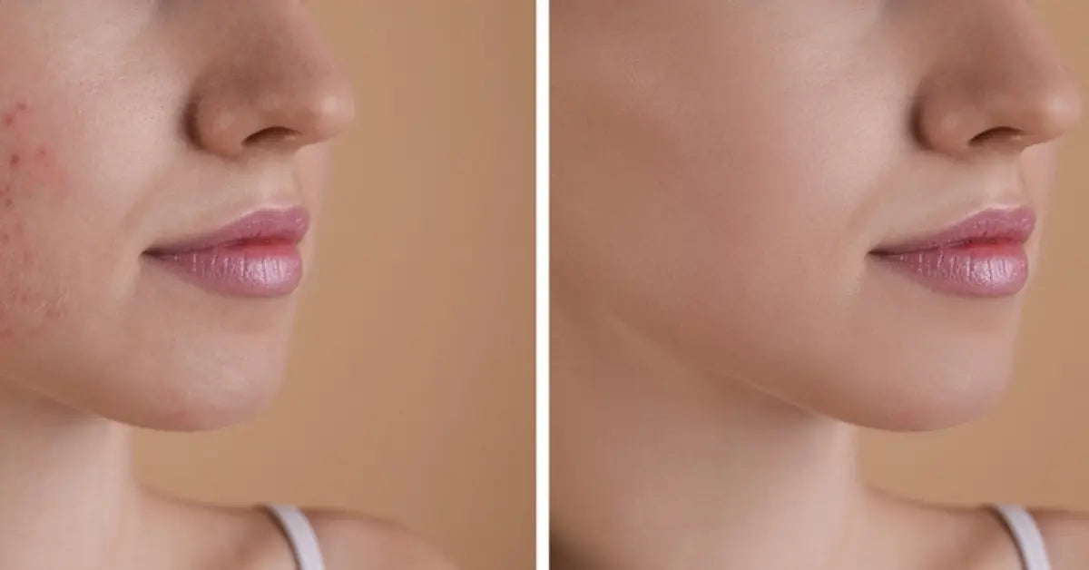 Before and after comparison of a successful Dark spots treatment