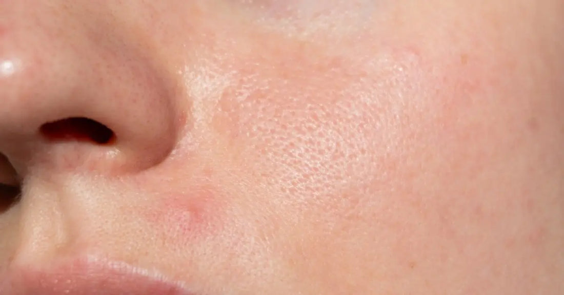 Applying niacinamide serum for oily skin to reduce shine and improve skin texture naturally