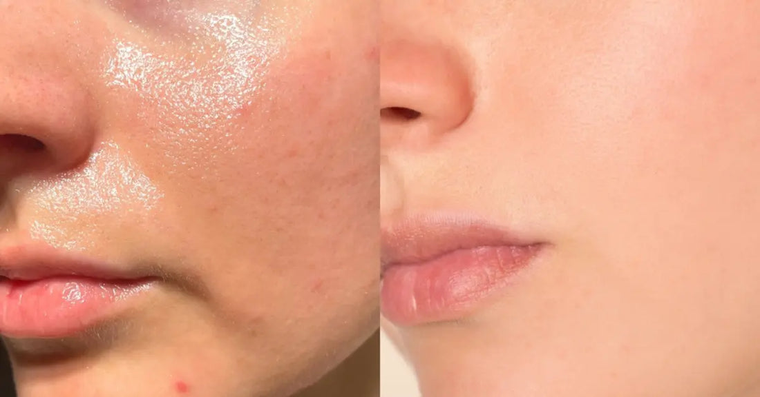 Real results of a balanced complexion using an Oily skin routine